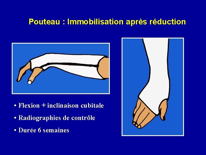 Pouteau : Immobilisation après réduction • Flexion + inclinaison cubitale • Radiographies de contrôle