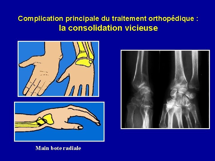 Complication principale du traitement orthopédique : la consolidation vicieuse Main bote radiale 