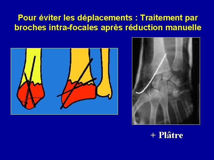 Pour éviter les déplacements : Traitement par broches intra-focales après réduction manuelle + Plâtre