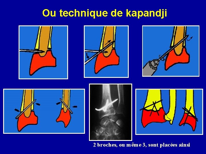 Ou technique de kapandji 2 broches, ou même 3, sont placées ainsi 