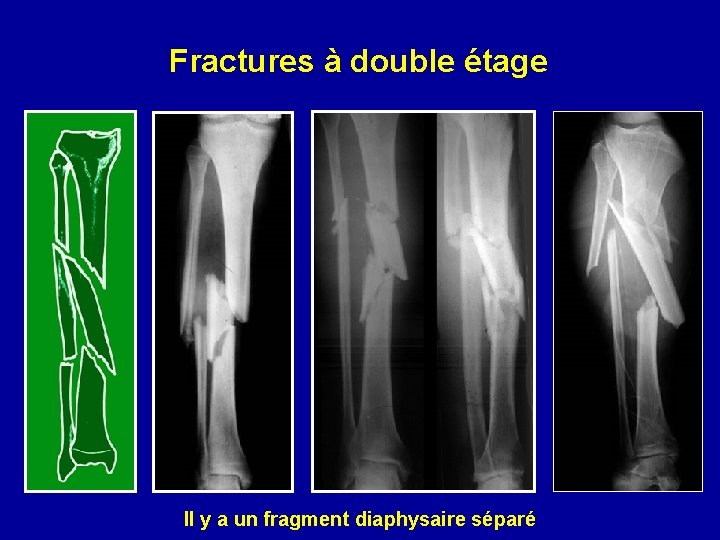 Fractures à double étage Il y a un fragment diaphysaire séparé 