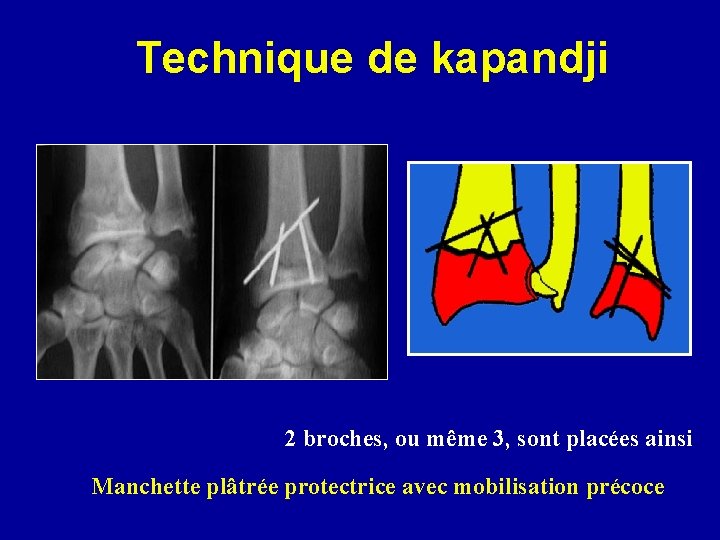 Technique de kapandji 2 broches, ou même 3, sont placées ainsi Manchette plâtrée protectrice