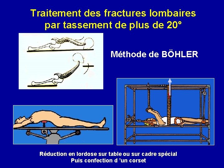 Traitement des fractures lombaires par tassement de plus de 20° Méthode de BÖHLER Réduction