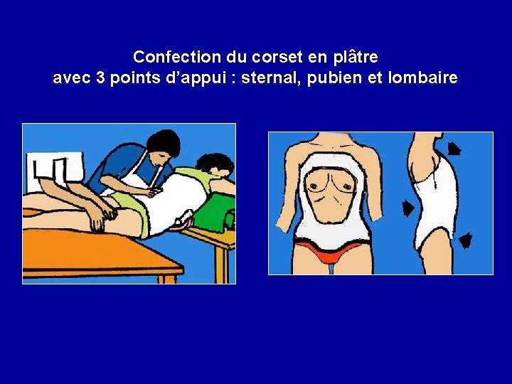 Confection du corset en plâtre avec 3 points d’appui : sternal, pubien et lombaire