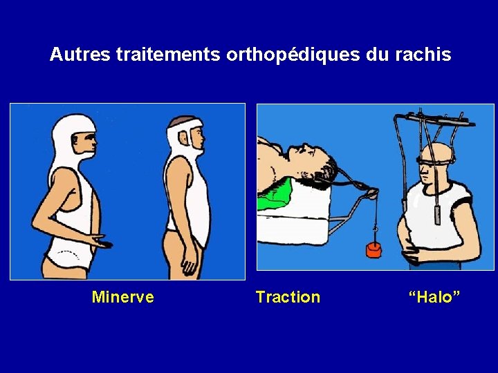 Autres traitements orthopédiques du rachis Minerve Traction “Halo” 