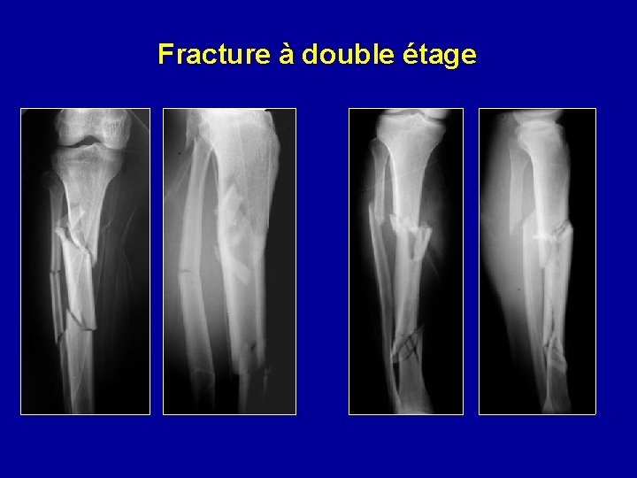 Fracture à double étage 