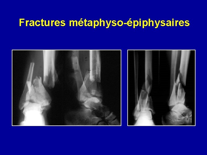 Fractures métaphyso-épiphysaires 