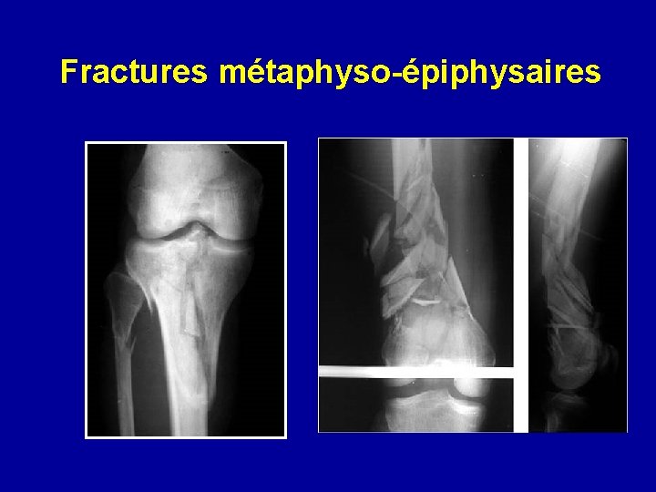 Fractures métaphyso-épiphysaires 