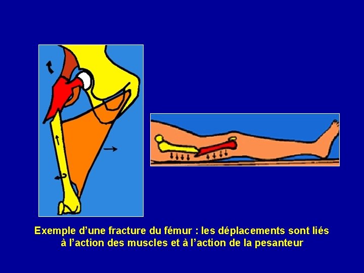 Exemple d’une fracture du fémur : les déplacements sont liés à l’action des muscles