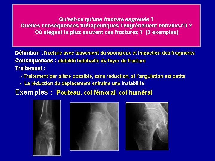 Qu'est-ce qu'une fracture engrenée ? Quelles conséquences thérapeutiques l’engrènement entraîne-t’il ? Où siègent le