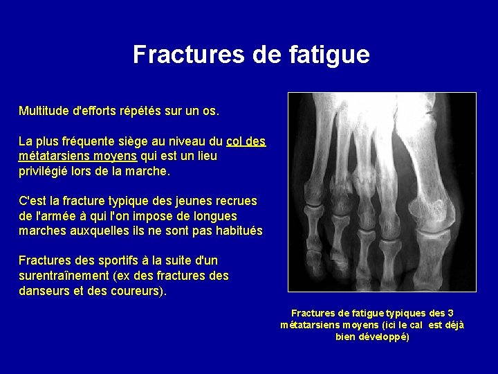 Fractures de fatigue Multitude d'efforts répétés sur un os. La plus fréquente siège au