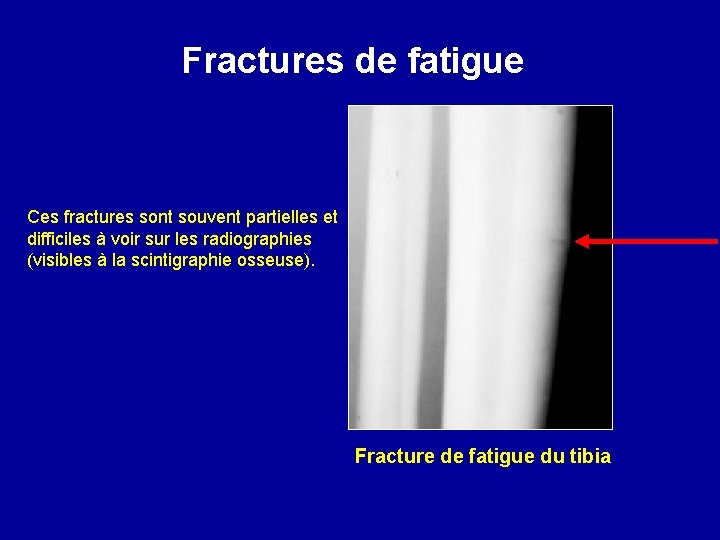 Fractures de fatigue Ces fractures sont souvent partielles et difficiles à voir sur les