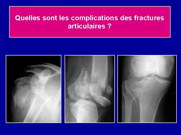 Quelles sont les complications des fractures articulaires ? 