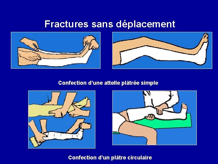 Fractures sans déplacement Confection d’une attelle plâtrée simple Confection d’un plâtre circulaire 