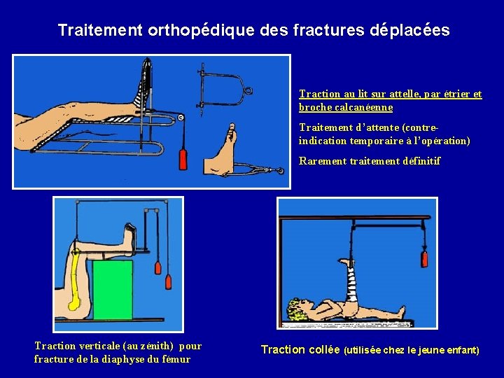 Traitement orthopédique des fractures déplacées Traction au lit sur attelle, par étrier et broche