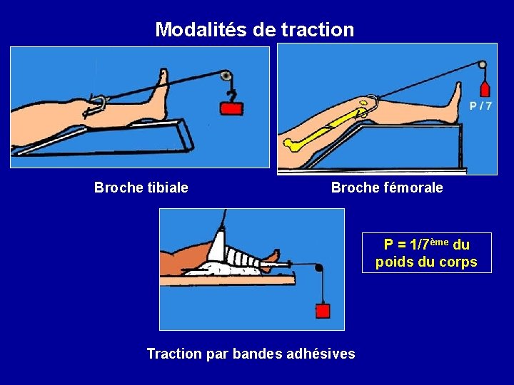 Modalités de traction Broche tibiale Broche fémorale P = 1/7ème du poids du corps