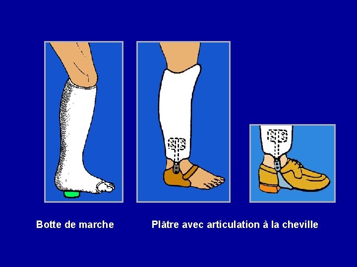 Botte de marche Plâtre avec articulation à la cheville 