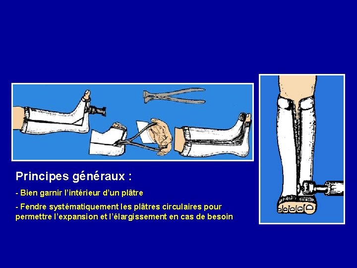 Principes généraux : - Bien garnir l’intérieur d’un plâtre - Fendre systématiquement les plâtres