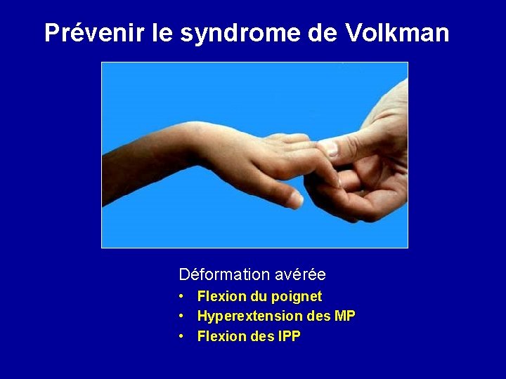 Prévenir le syndrome de Volkman Déformation avérée • Flexion du poignet • Hyperextension des