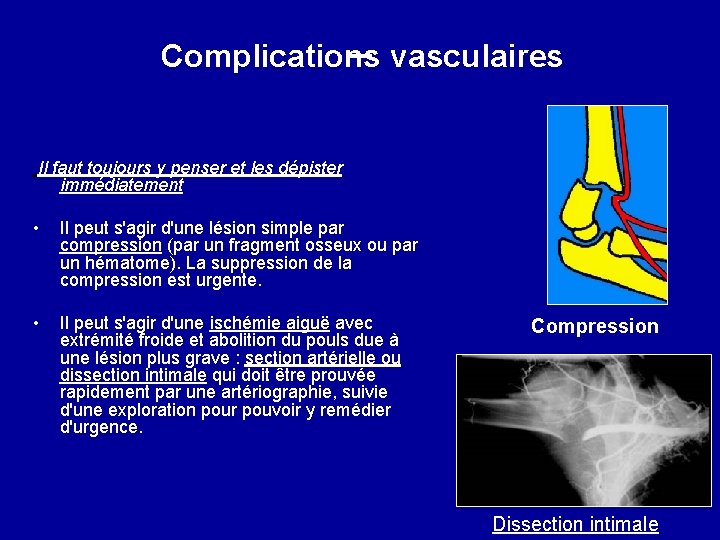 Complications vasculaires Il faut toujours y penser et les dépister immédiatement • Il peut