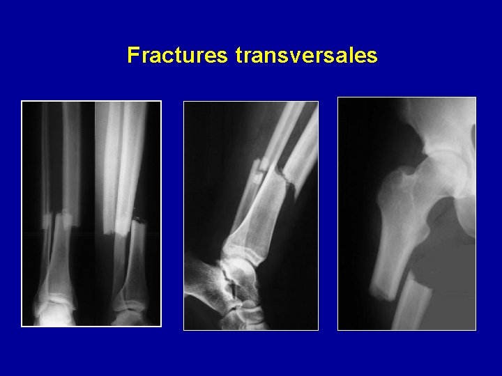 Fractures transversales 