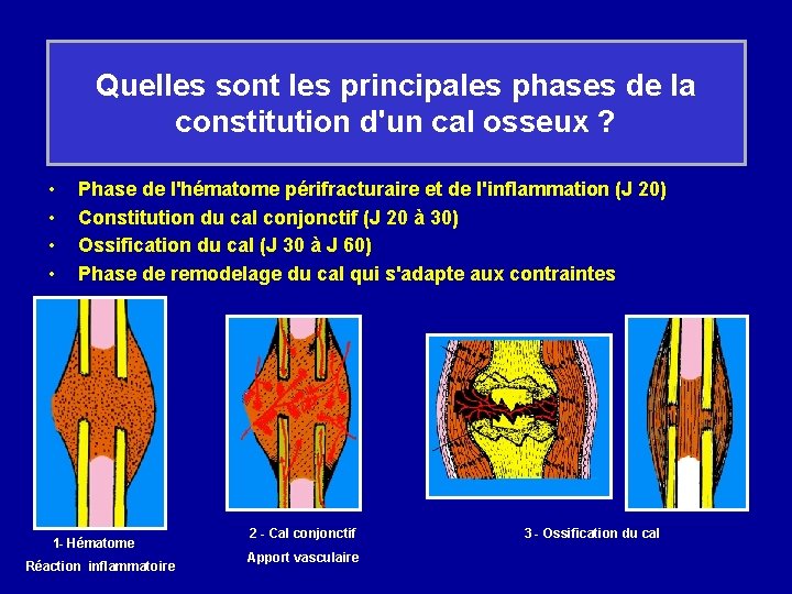 Quelles sont les principales phases de la constitution d'un cal osseux ? • •