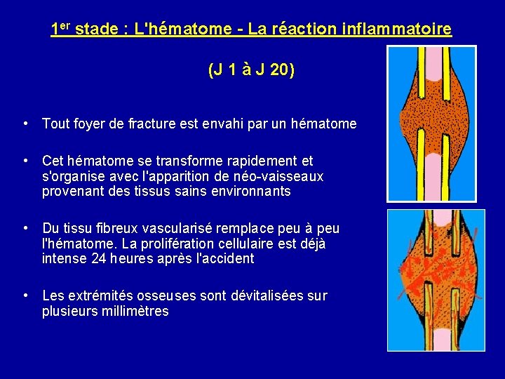 1 er stade : L'hématome - La réaction inflammatoire (J 1 à J 20)