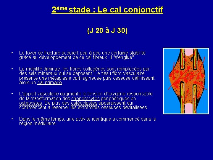 2ème stade : Le cal conjonctif (J 20 à J 30) • Le foyer