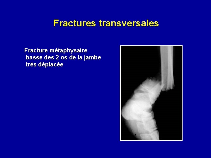 Fractures transversales Fracture métaphysaire basse des 2 os de la jambe très déplacée 