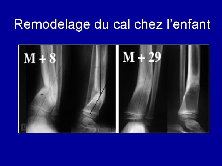 Remodelage du cal chez l’enfant 