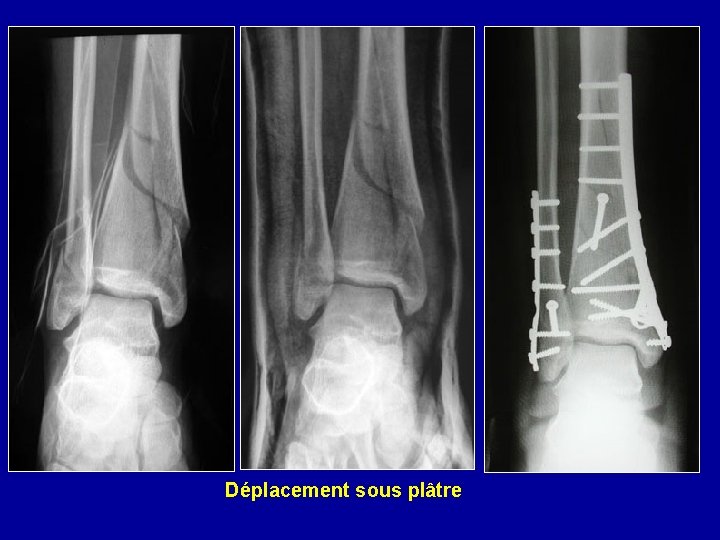 Déplacement sous plâtre 