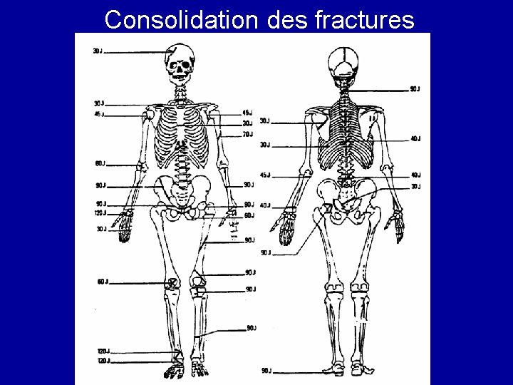 Consolidation des fractures 