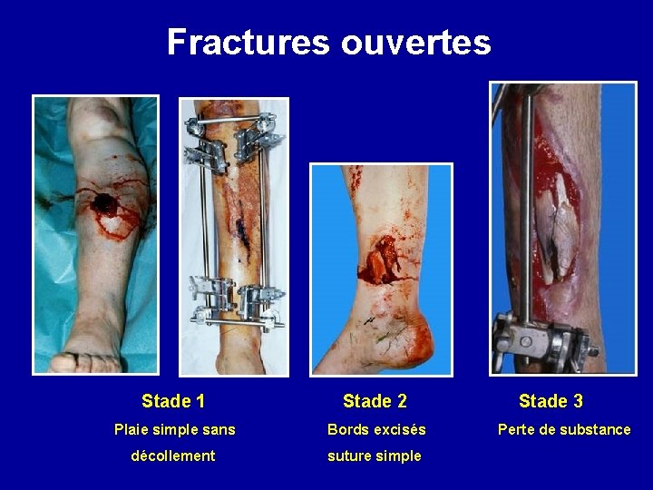 Fractures ouvertes Stade 1 Stade 2 Stade 3 Plaie simple sans Bords excisés Perte