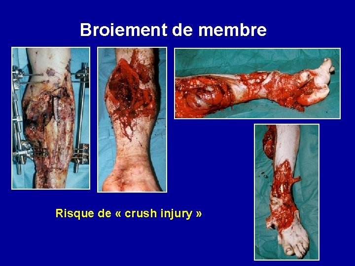 Broiement de membre Risque de « crush injury » 