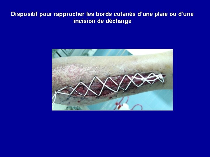 Dispositif pour rapprocher les bords cutanés d’une plaie ou d’une incision de décharge 