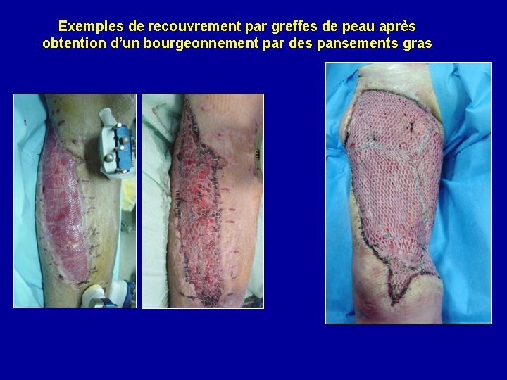 Exemples de recouvrement par greffes de peau après obtention d’un bourgeonnement par des pansements