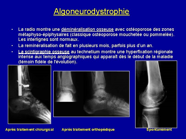 Algoneurodystrophie • • • La radio montre une déminéralisation osseuse avec ostéoporose des zones