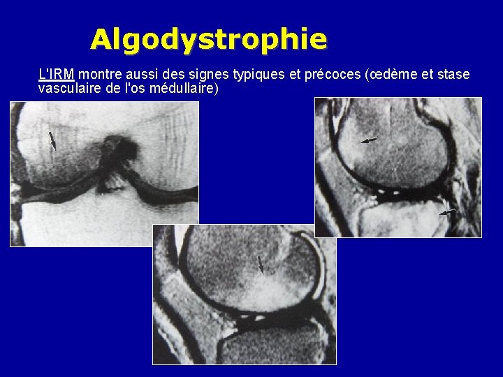 Algodystrophie L'IRM montre aussi des signes typiques et précoces (œdème et stase vasculaire de