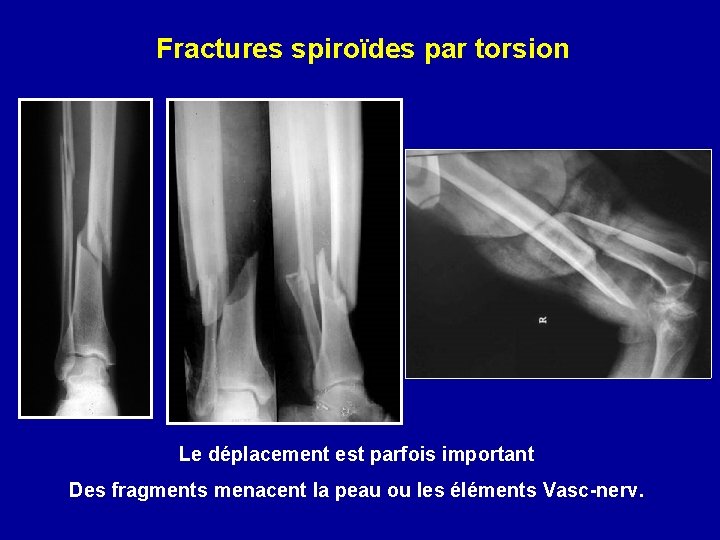 Fractures spiroïdes par torsion Le déplacement est parfois important Des fragments menacent la peau