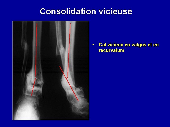 Consolidation vicieuse • Cal vicieux en valgus et en recurvatum 