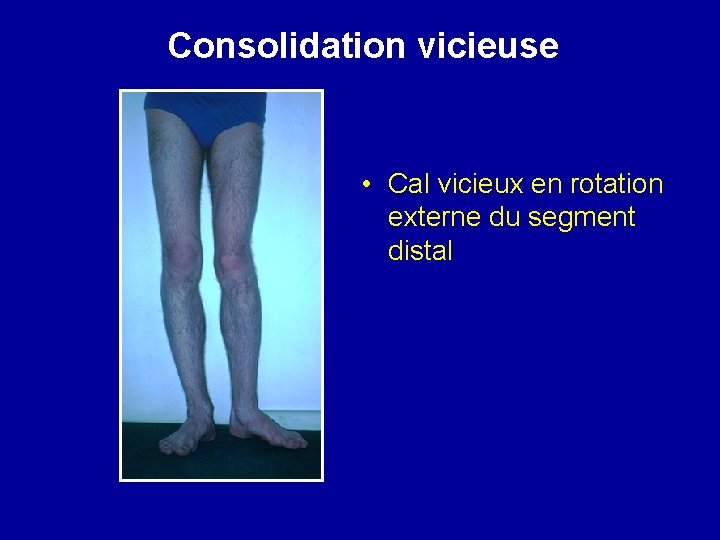 Consolidation vicieuse • Cal vicieux en rotation externe du segment distal 