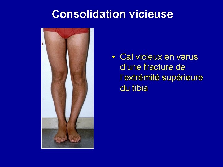 Consolidation vicieuse • Cal vicieux en varus d’une fracture de l’extrémité supérieure du tibia