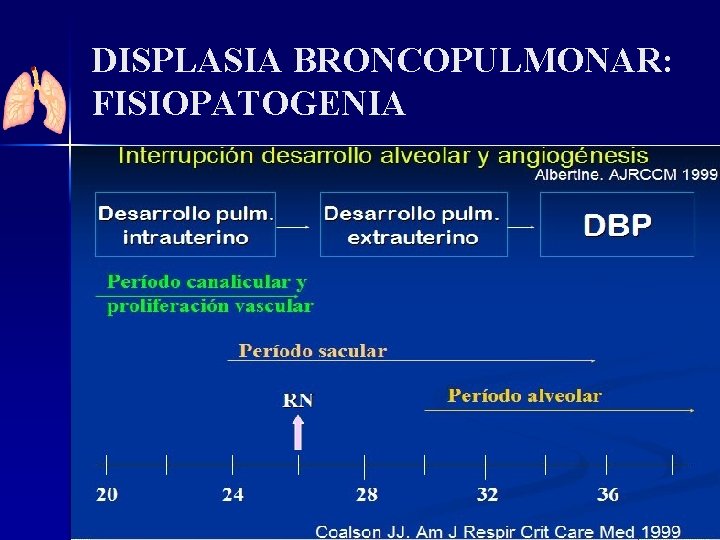 DISPLASIA BRONCOPULMONAR: FISIOPATOGENIA 