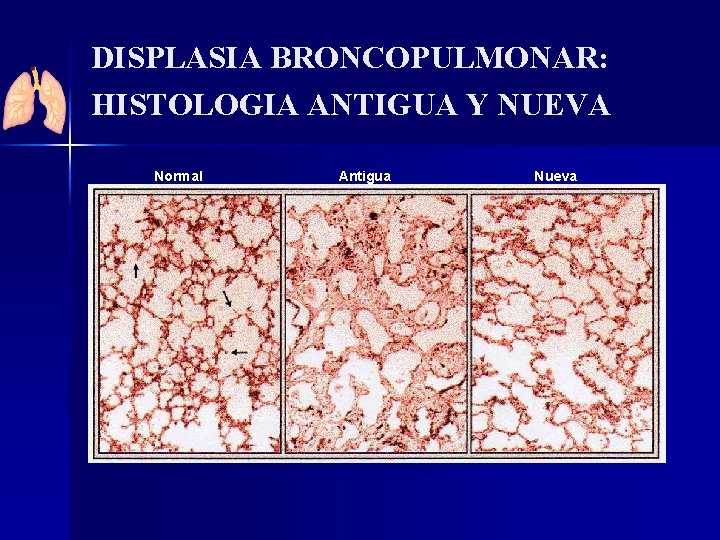 DISPLASIA BRONCOPULMONAR: HISTOLOGIA ANTIGUA Y NUEVA Normal Antigua Nueva 