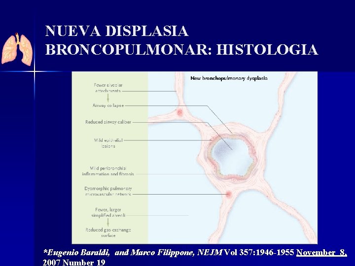 NUEVA DISPLASIA BRONCOPULMONAR: HISTOLOGIA *Eugenio Baraldi, and Marco Filippone, NEJM Vol 357: 1946 -1955