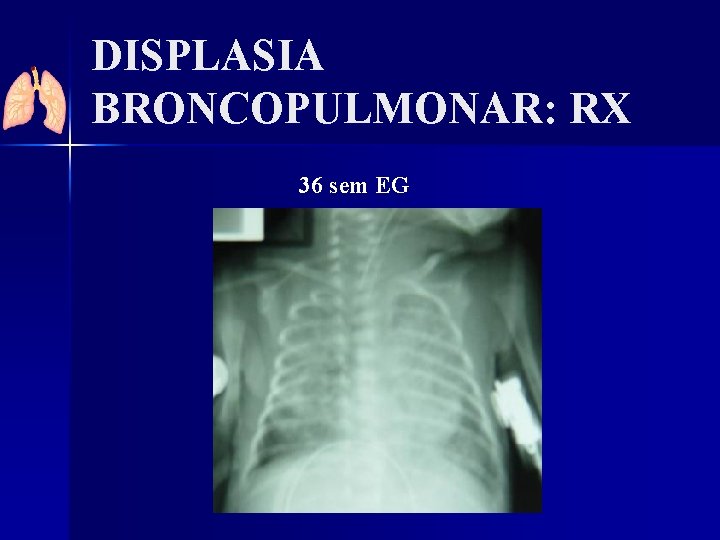 DISPLASIA BRONCOPULMONAR: RX 36 sem EG 