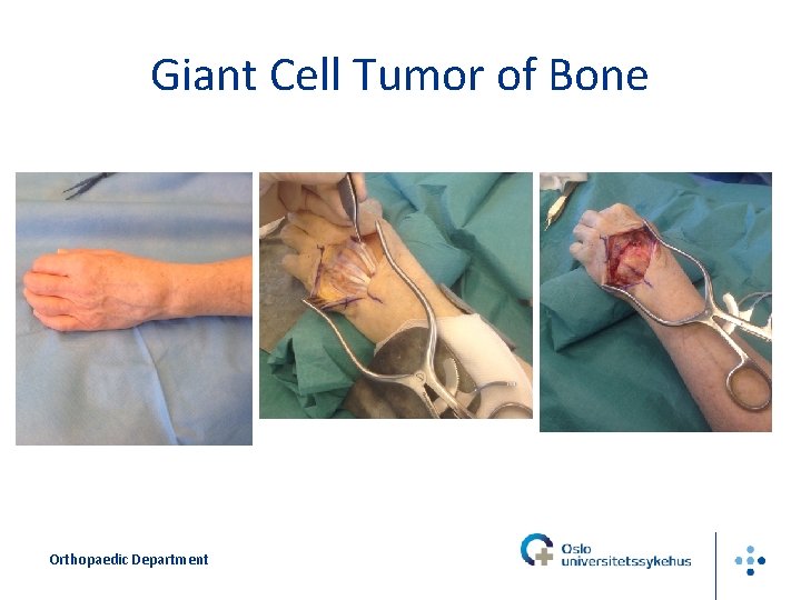 Giant Cell Tumor of Bone Orthopaedic Department 