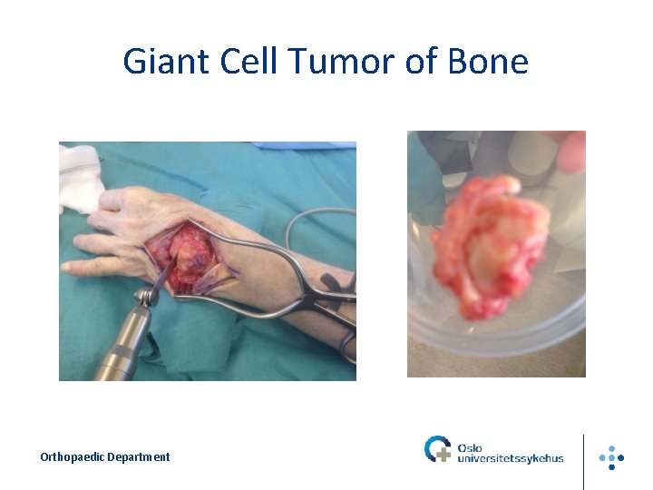 Giant Cell Tumor of Bone Orthopaedic Department 