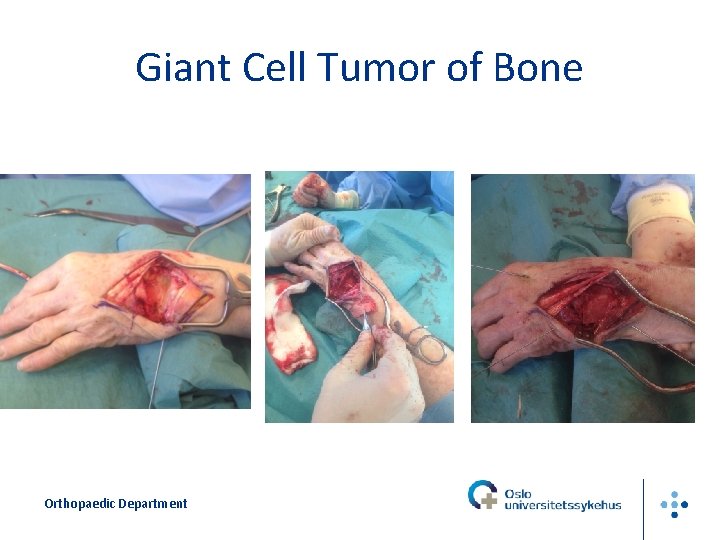 Giant Cell Tumor of Bone Orthopaedic Department 