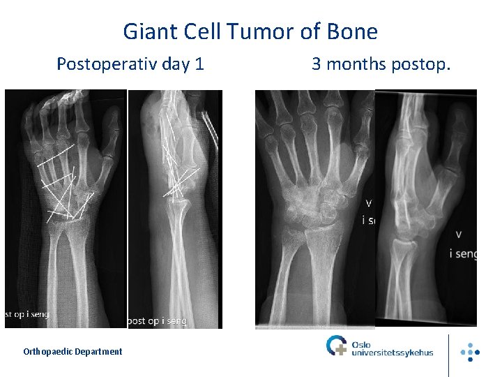 Giant Cell Tumor of Bone Postoperativ day 1 Orthopaedic Department 3 months postop. 